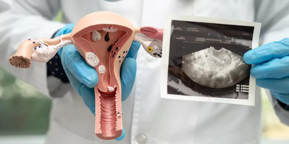 تاثیر تنبلی تخمدان در بارداری