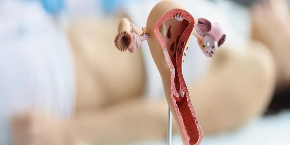 بررسی علل تنبلی تخمدان